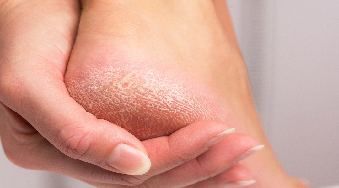 Can A Podiatrist Remove Dead Skin on the Feet